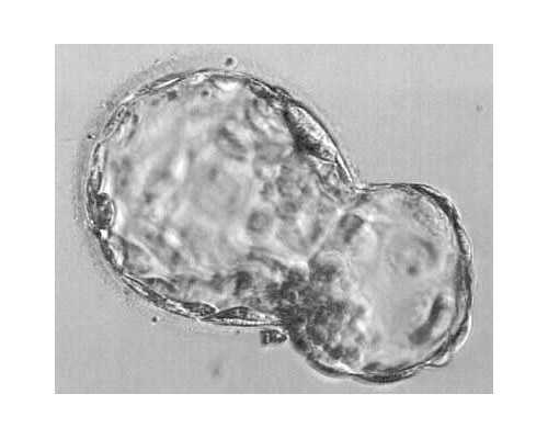 预防子宫肌瘤:了解早期症状